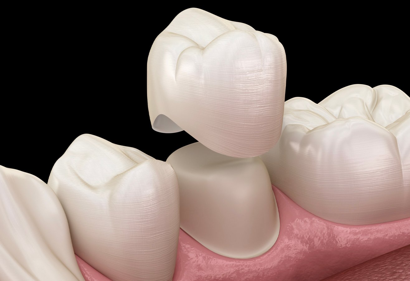 Crowns & Bridges