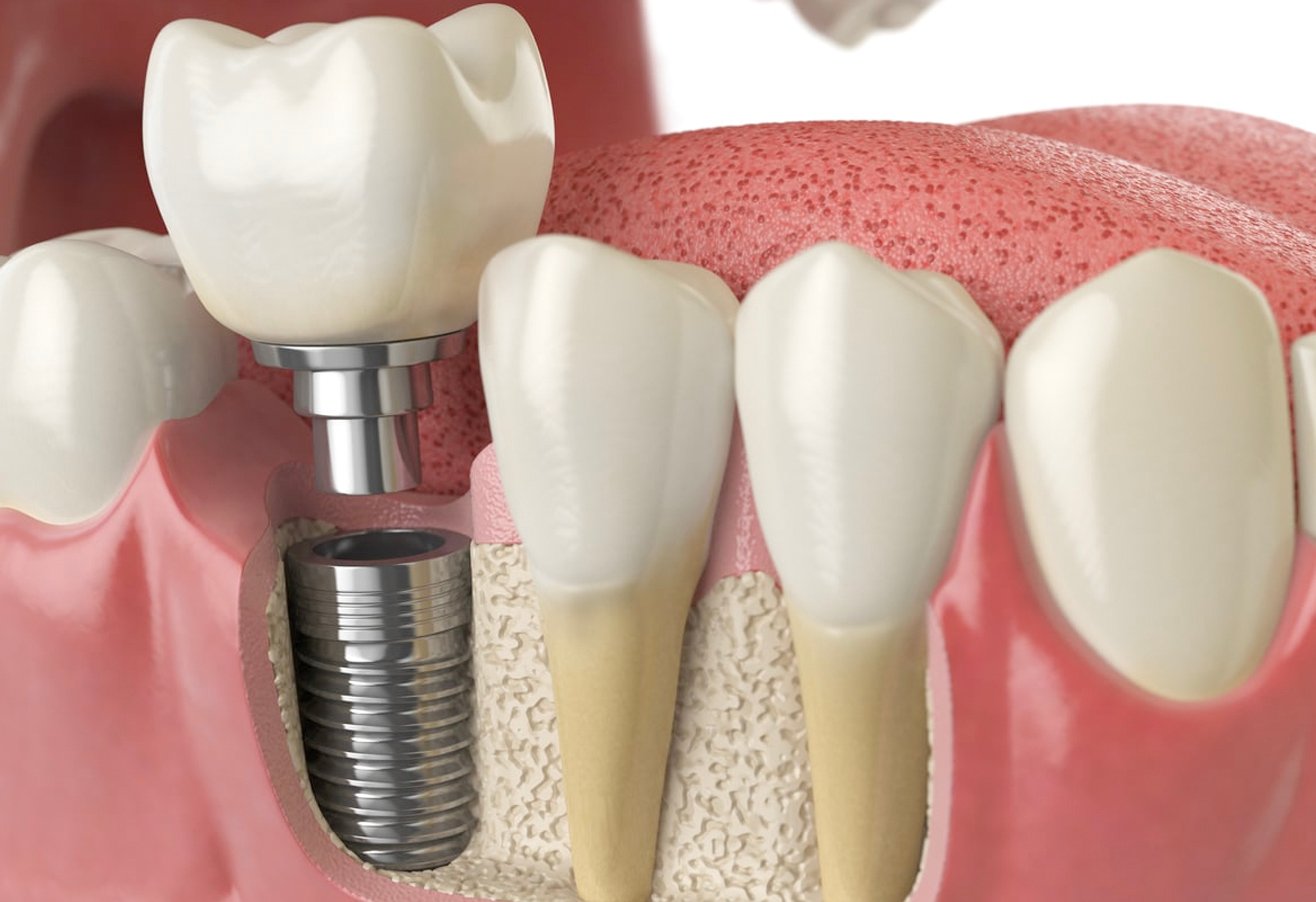 Dental Implants in Udaipur