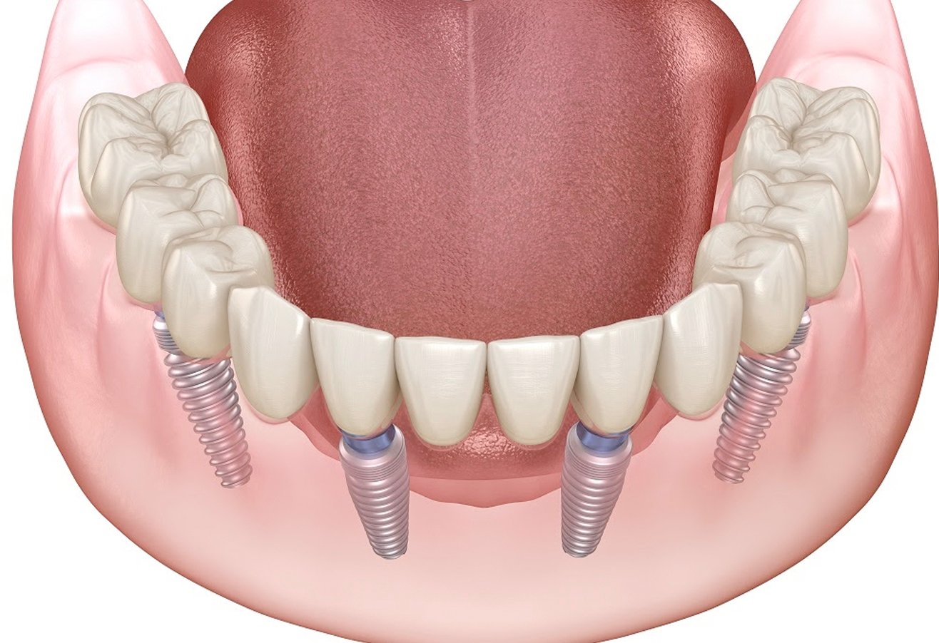 Full Mouth Rehabilitation