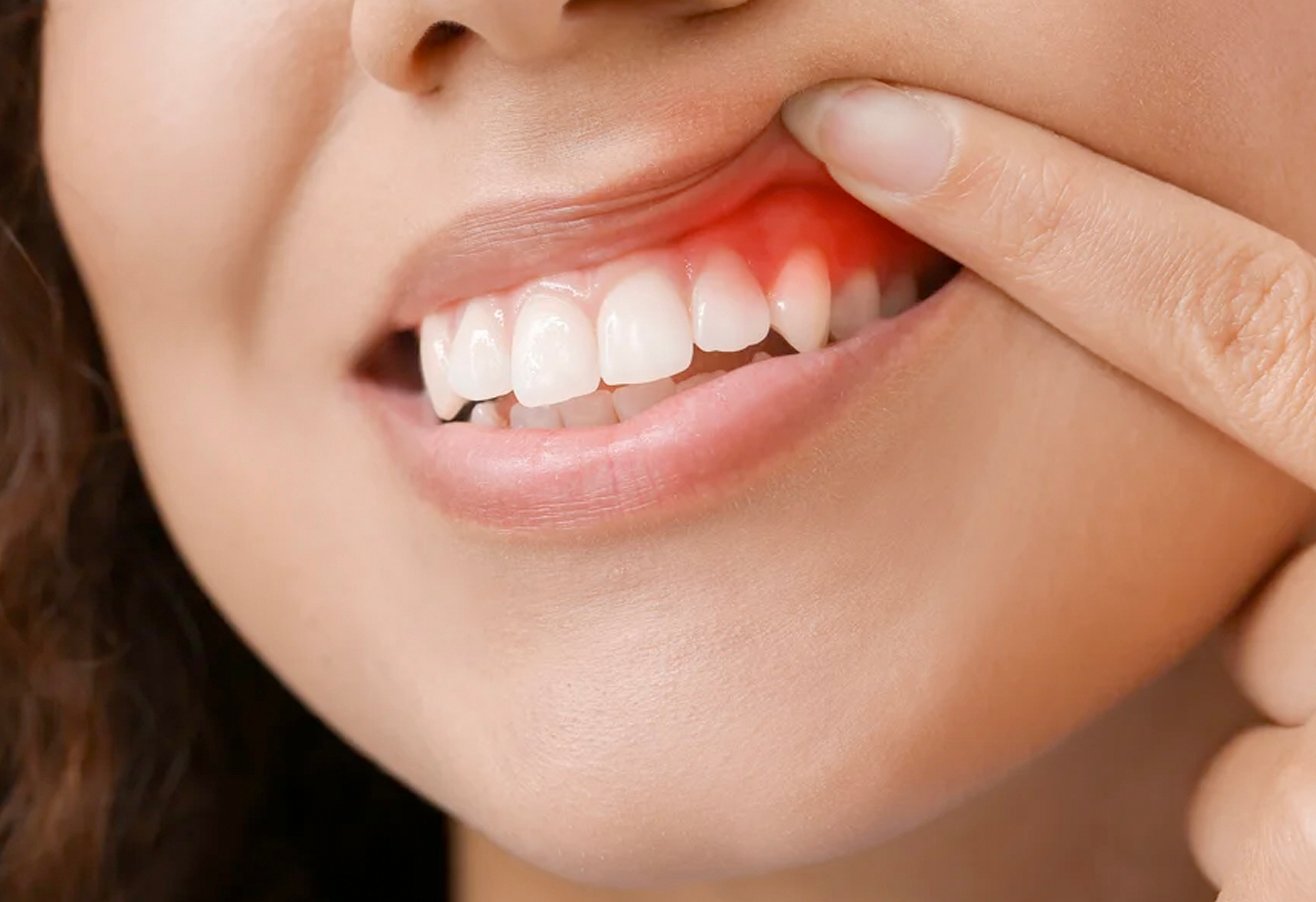 Gum Treatment (Periodontics)
