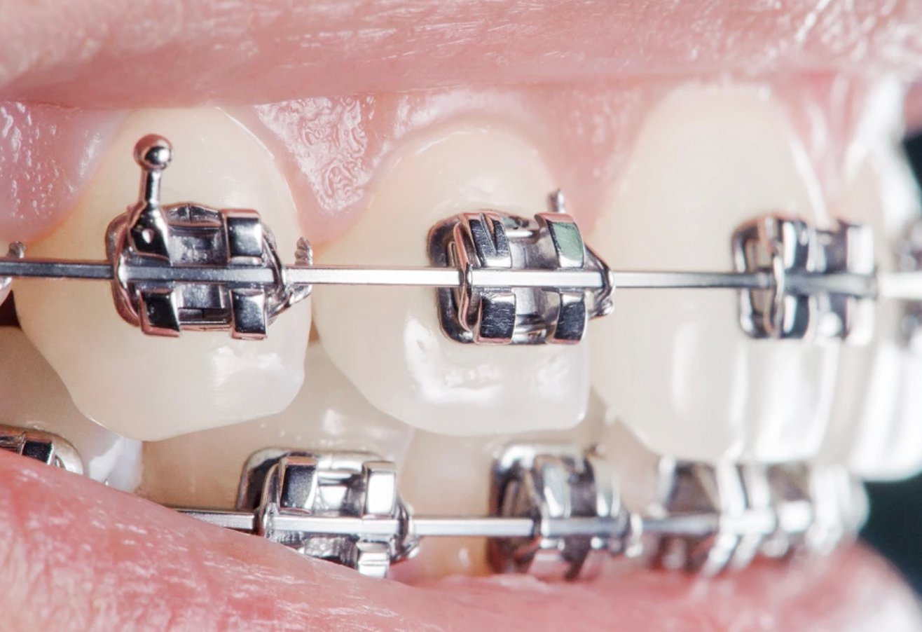 Orthodontics & Braces