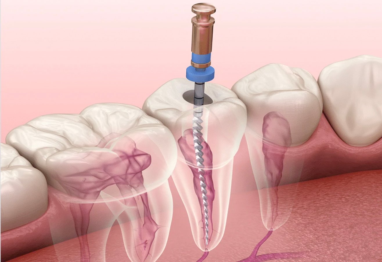 Root Canal Treatment (RCT)
