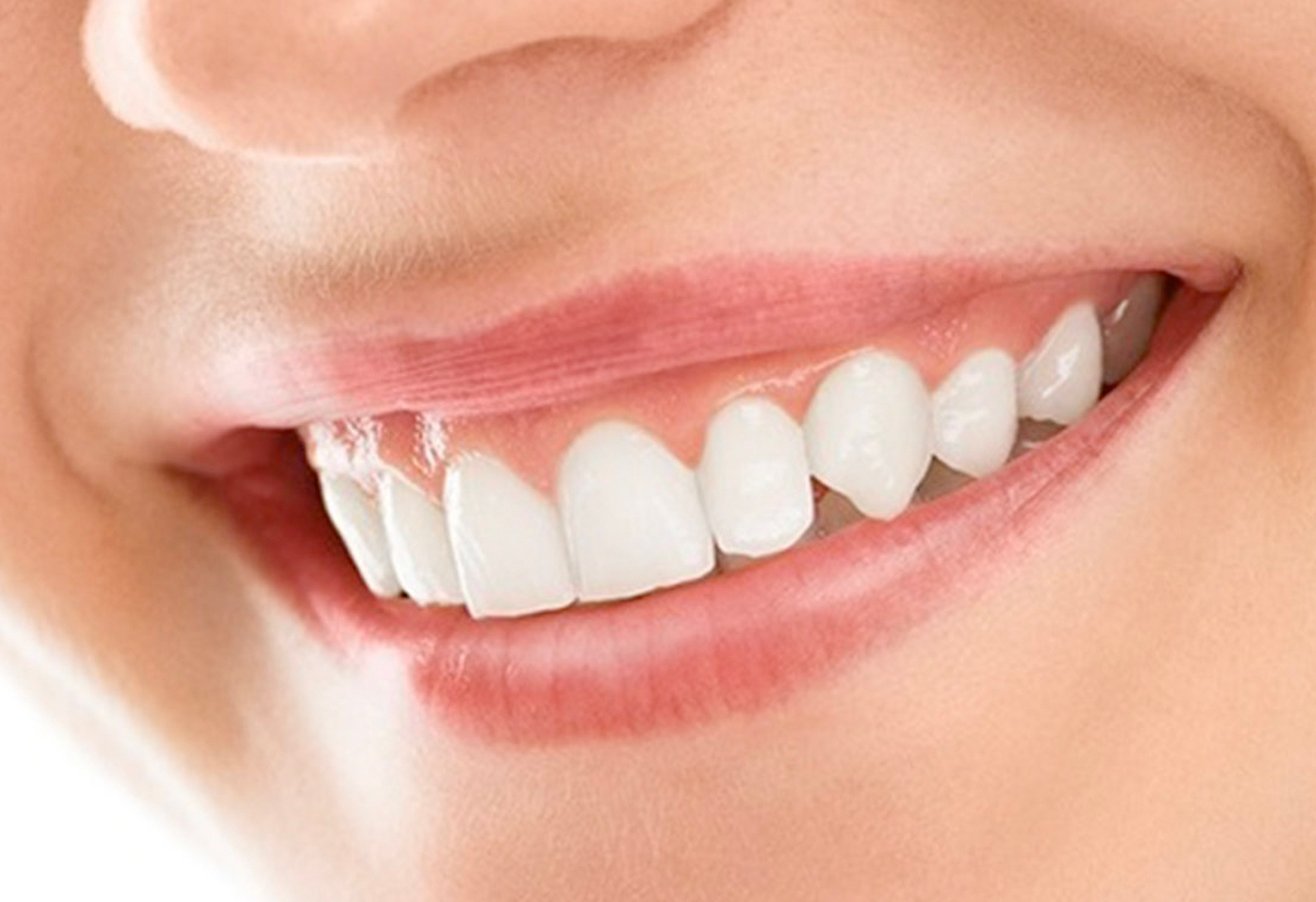 Smile Makeover – Udaipur